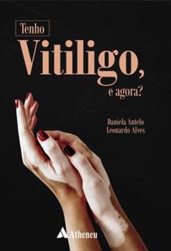 Imagem de TENHO VITILIGO, E AGORA?